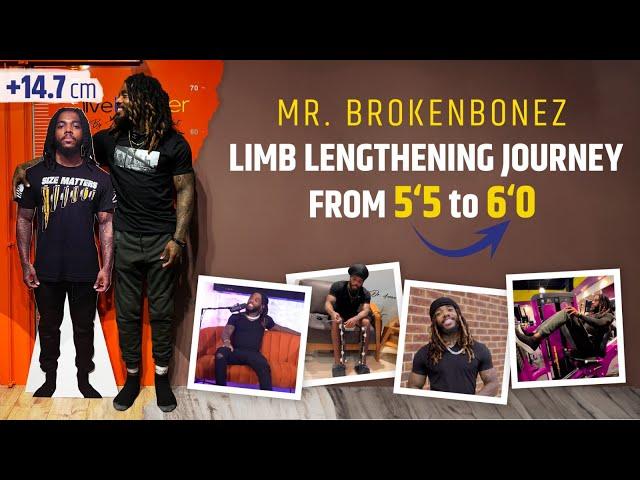 MR. BROKENBONES LIMB LENGTHENING JOURNEY FROM 5‘5 TO 6‘0