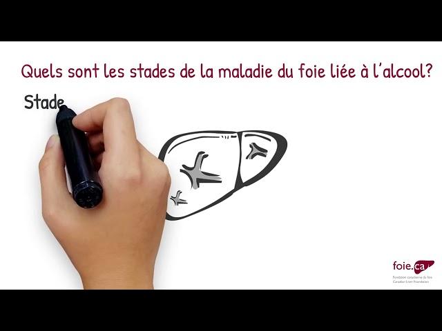 Les différents stades de la maladie du foie liée à l’alcool