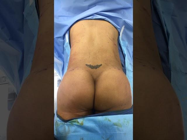Dr. Reynolds - Brazilian Butt Lift after injection