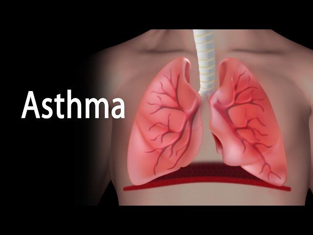 Asthma, Animation.