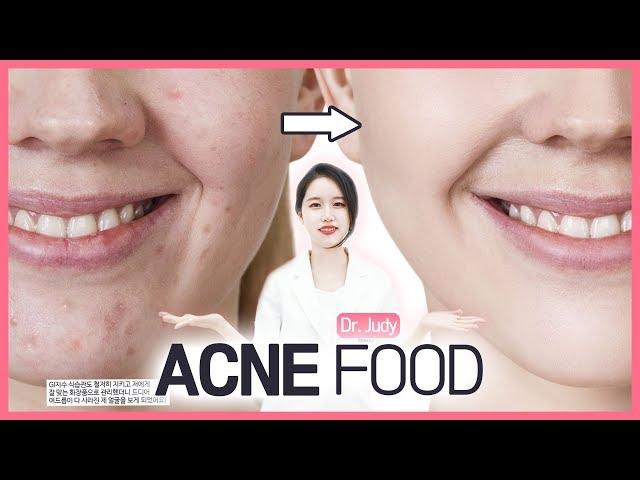 Bad and good food for pimples, acne/Korean dermatologist Judy's scientific Skincare