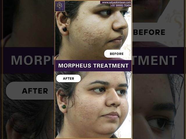 Morpheus 8 | Morpheus Treatment Before After | Morpheus Treatment for acne Scars #acnescars #acne