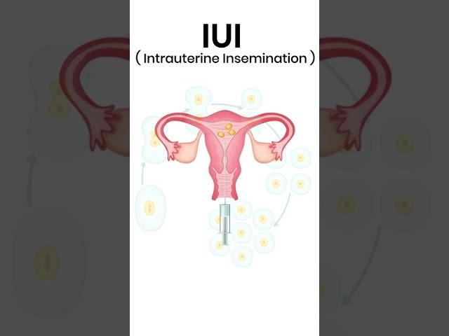 IUI Process |  Pravi Test Tube Baby Centre Kanpur
