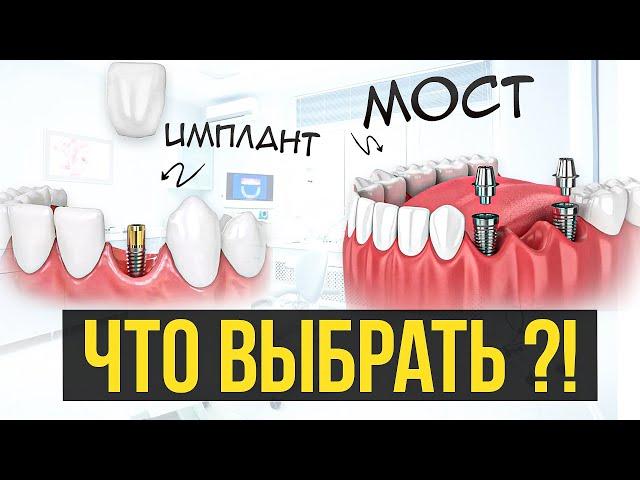 Зубной МОСТ или ИМПЛАНТАЦИЯ зубов — что выбрать? Плюсы минусы!