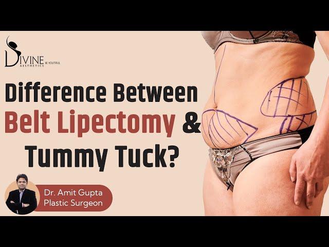 What is the Difference between Belt Lipectomy & Tummy Tuck?