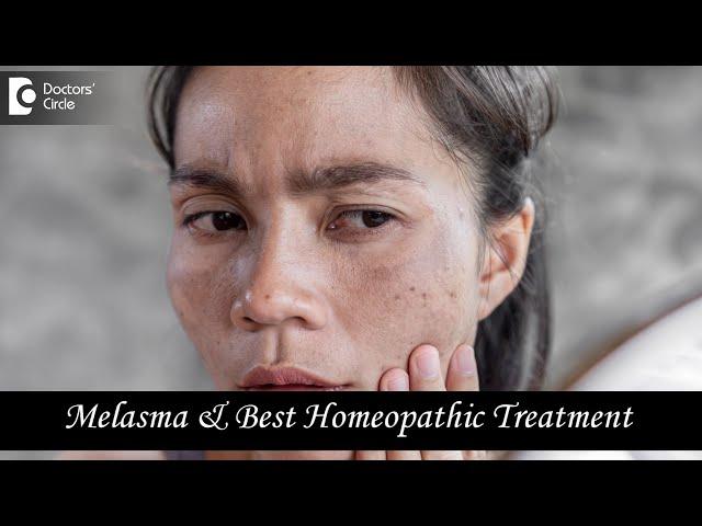 MELASMA OR CHLOASMA | Causes and Best Homeopathic Treatment - Dr. V. Bhagyalakshmi | Doctors' Circle