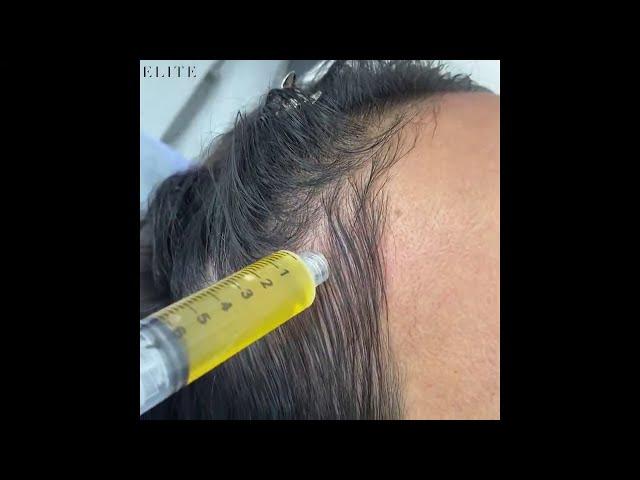 Vampire PRP Hair Restoration | Know About This Amazing Treatment | Elite Aesthetics