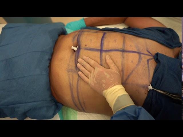 Gynecomastia Surgery: Vaser Liposculpture, Renuvion & Fat Grafting | Dr. Lebowitz