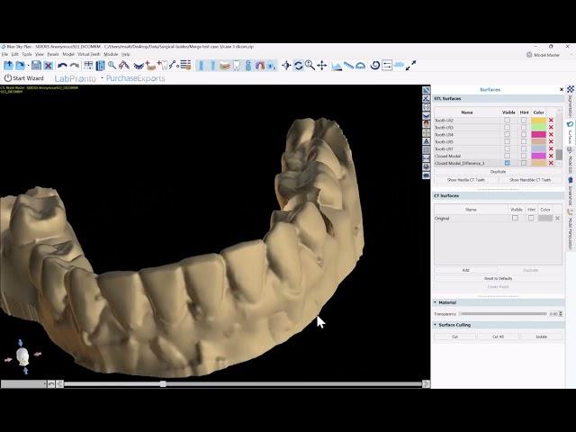 BSP4.12: Extracting a Tooth from A Model While Retaining the Emergence Profile