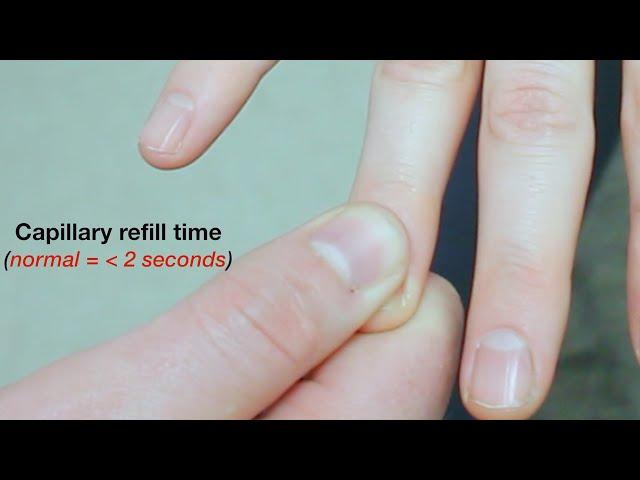 Capillary Nail Refill