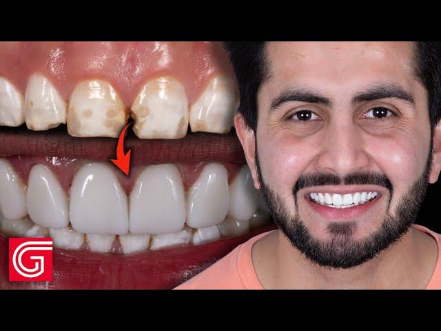 HOW TO Deliver 10 Cosmetic Veneers for Enamel Hypoplasia Patient