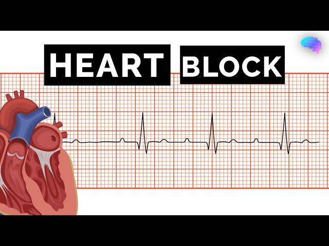 Heart Block | AV Block | ECG | EKG | OSCE Guide | UKMLA | CPSA | PLAB 2