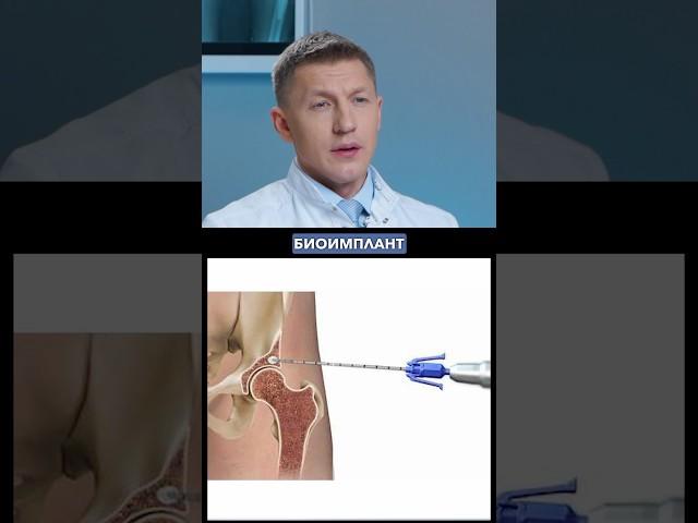 Что такое биоимплант тазобедренного сустава