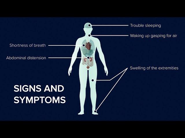 What is Heart Failure? Causes, Symptoms and Treatment