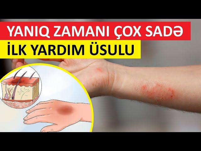 Yanıq zamanı çox sadə YARDIM ÜSULU