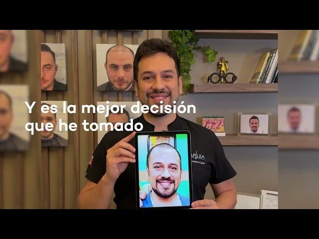 RECUPERA TU CABELLO CON INJERTO CAPILAR/ CAPILEA MEXICO