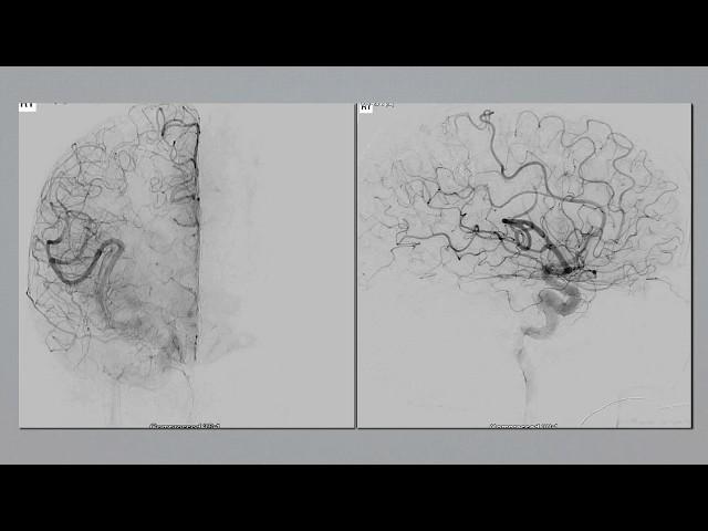 Motor cortex arteriovenous malformation