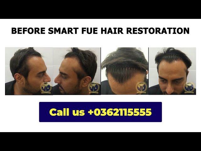 8 Months After SMART FUE Hair Restoration: Transformation | Glojas Aesthetic Clinic