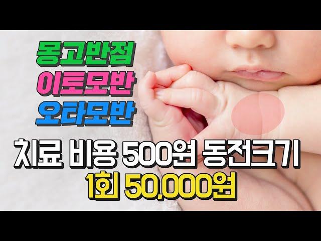 몽고반점 이토모반 오타모반 치료비용 / 500원 동전크기 피코레이저 시술 50000원/아기 반점 치료