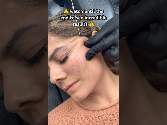 ‼️ TW ‼️ Would you try a thread lift?  Results at the end! #threadlift #threads #beauty