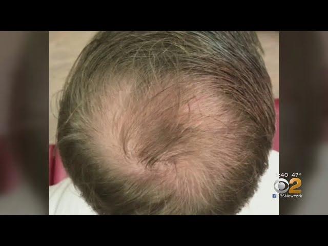 Can PRP Injections Spark Hair Growth?