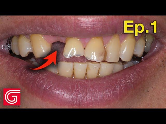 HOW TO Restore DENTAL Occlusion with Missing Tooth #7 | Ep 1