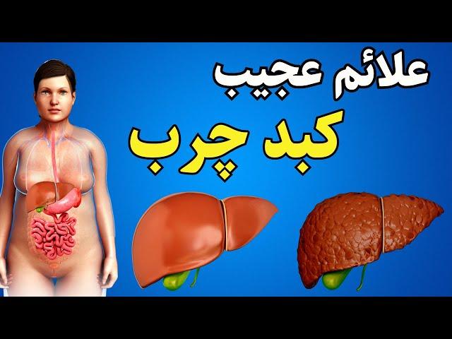 علائم کبد چرب | 7 علائمی که نشون میده شما کبد چرب دارید