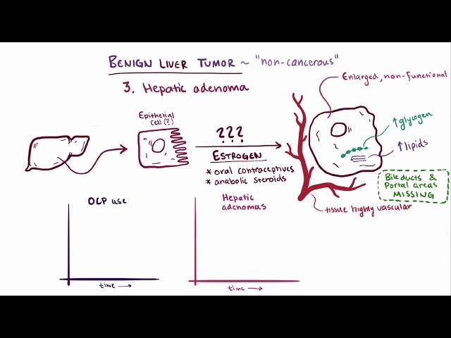 Benign liver tumors   causes, symptoms, diagnosis, treatment & pathology