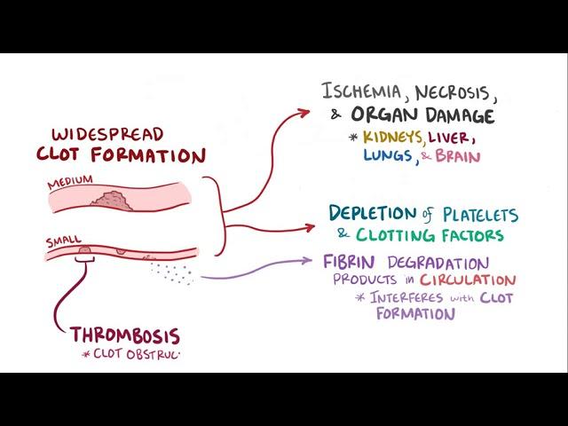 Disseminated intravascular coagulation   causes  symptoms  diagnosis  treatment  pathology