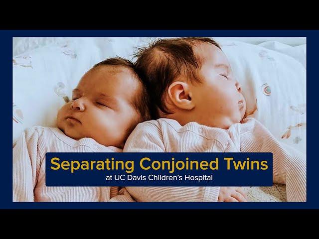 Separating Conjoined Twins at UC Davis Children's Hospital