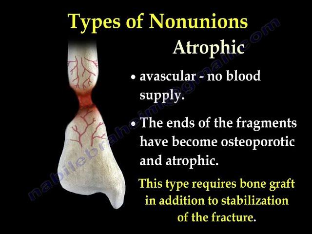 NONUNION OF FRACTURES CAUSES, TYPES AND TREATMENT