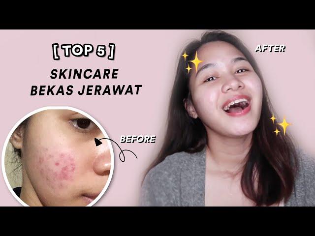 SKINCARE UNTUK BEKAS JERAWAT MERAH, COKLAT, HITAM | Niacinamide, Vit C, AHA!