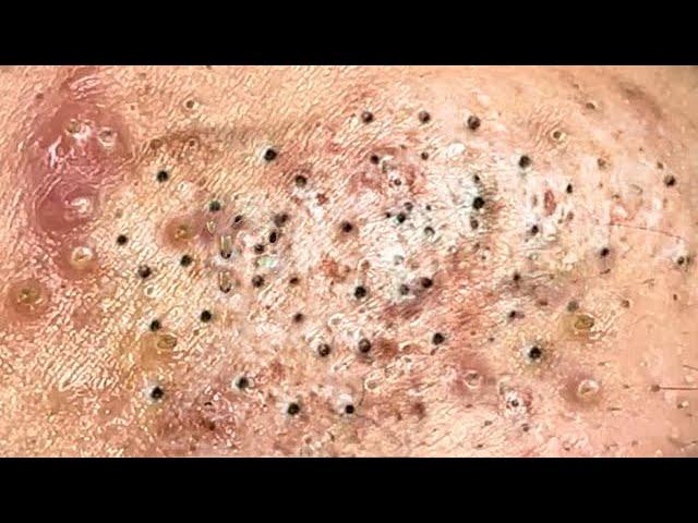 Loan Nguyen Acne Treatment 4264