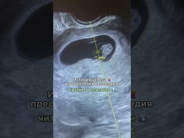 История успеха пациентки клиники Центр ЭКО Виталис Москва