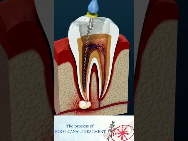 Root Canal Treatment & Tooth Abscess