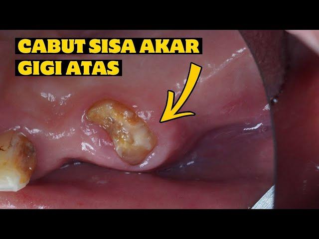 CABUT GIGI | SISA AKAR GIGI | PENCABUTAN GIGI ATAS | Dentist | Dokter Gigi Tri Putra