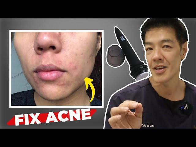 Getting Rid of Acne Scars at Home : Microneedling | Dr Davin Lim