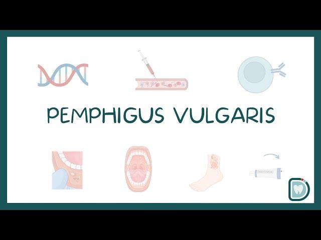 Pemphigus Vulgaris: Oral Cavity Symptoms and Treatment