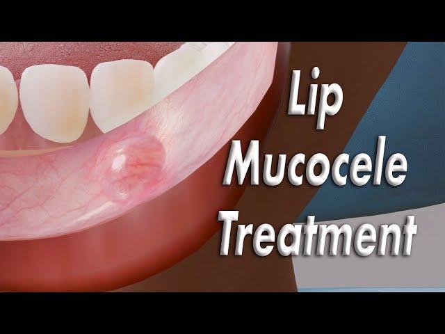 Inner Lip Mucocele (Inside Lip Bump) Surgical Treatment