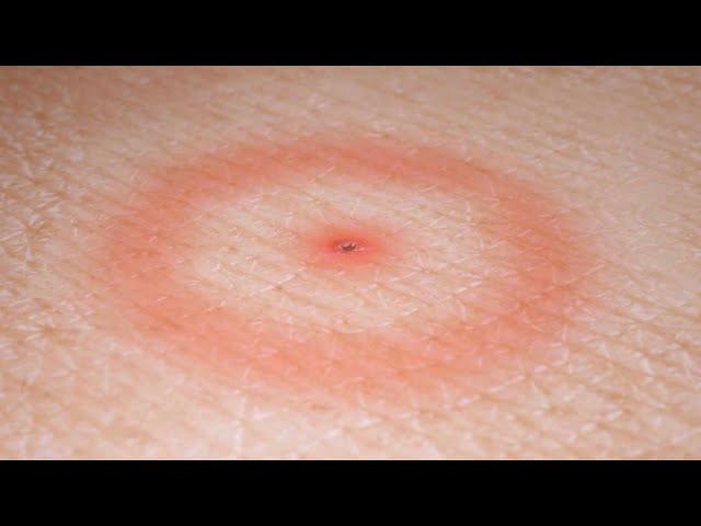 Lyme Disease: Symptoms and Treatments