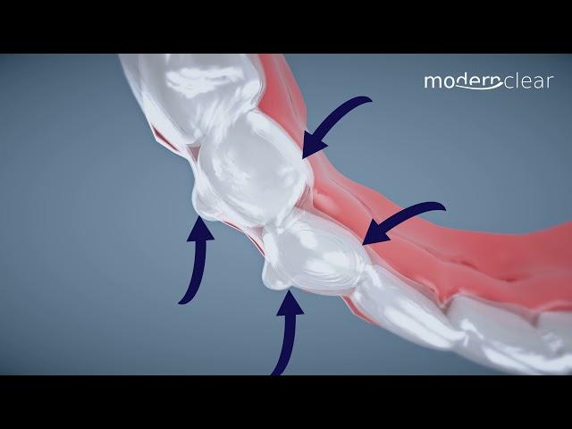 Modern Clear How it works - Frederick Dental Clinic