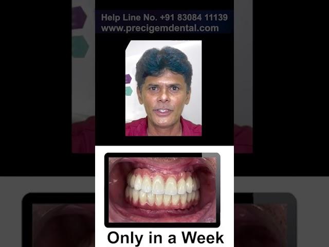 Full Mouth Dental Implant - Dr Mayur Khairnar