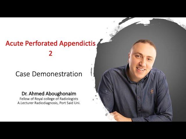 | GIT | Emergency | Acute perforated Appendicitis | 2 |