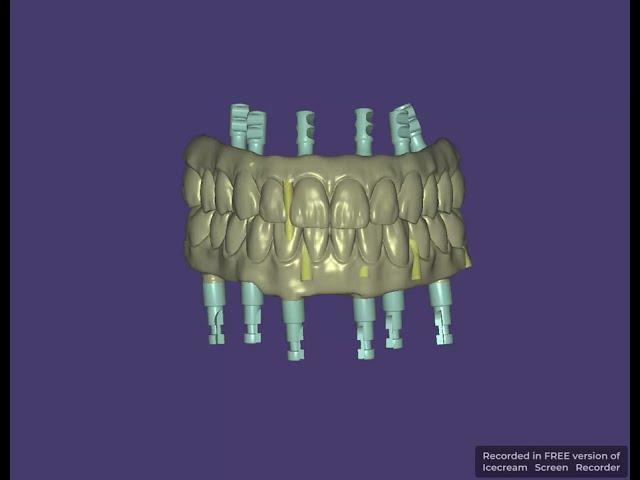 Full Mouth Implant bridge design