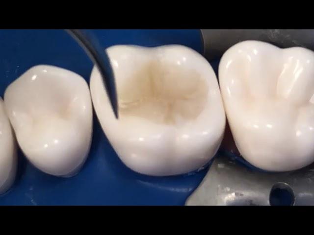 simplified technique to restore class I  upper 6 with resin composite