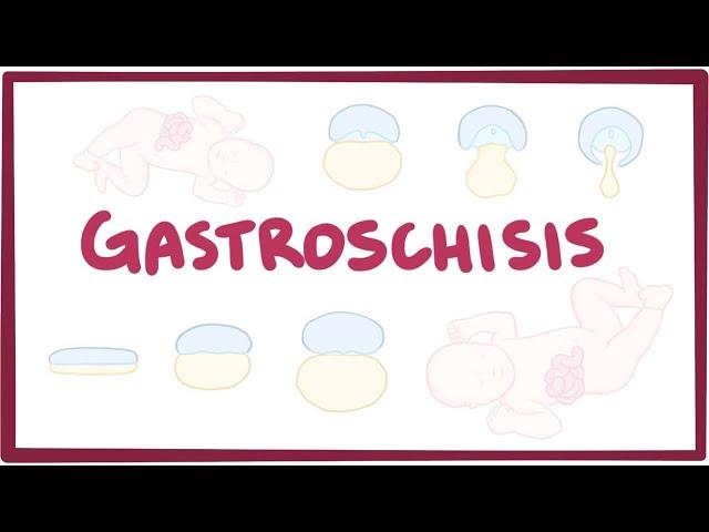 Gastroschisis - causes, symptoms, diagnosis, treatment, pathology