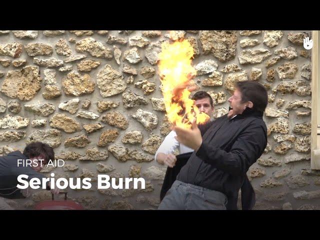 Learn first aid gestures: Serious Burn