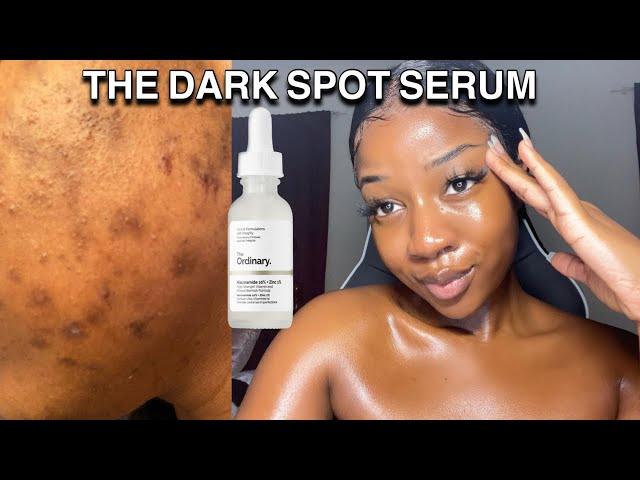 HOW TO GET RID OF DARK SPOTS WITH ONE PRODUCT | The ordinary