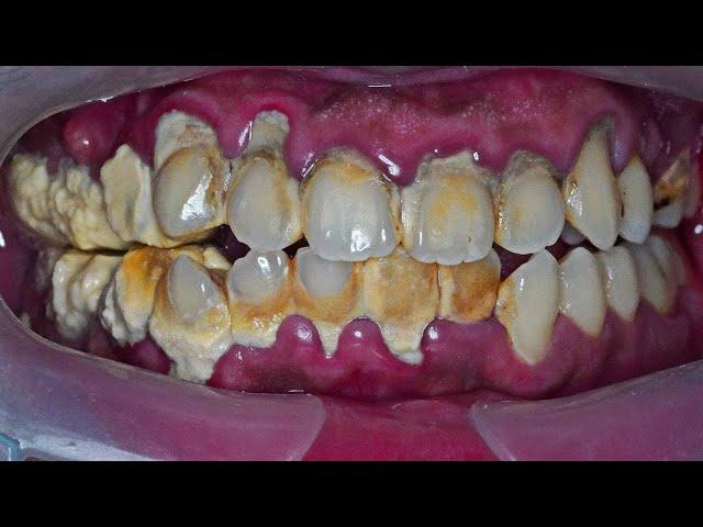 25-Minute Scaling Process Video | Tartar | Dentist | Dokter Gigi Tri Putra