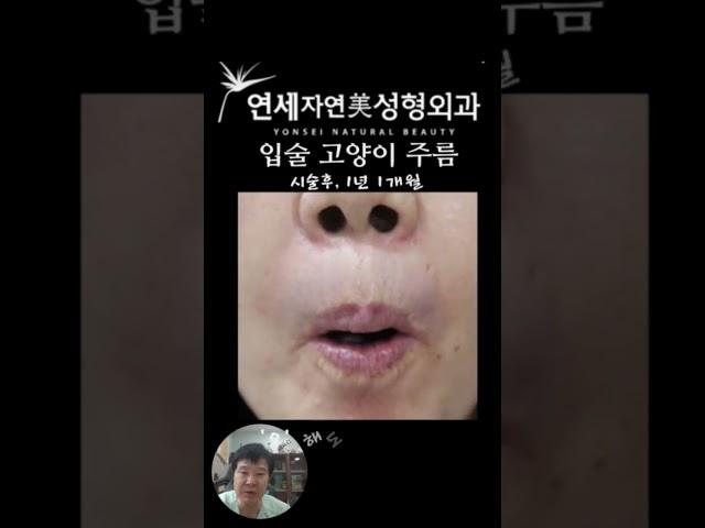 입술 세로주름의 영구적교정 #연세자연미성형외과 #고양이주름#인중주름#치마주름#신촌성형외과 #홍대성형외과